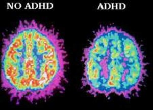 What does it mean to have adult ADHD? Does it make us who we are? Who would we be without it? Does adult ADHD affect our identities?