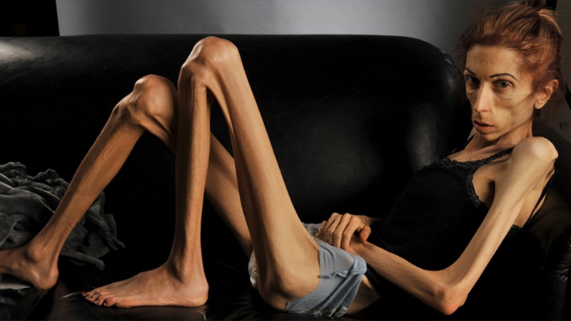Eating Disorders: Anorexia Nervosa - The Most Deadly Mental Illness