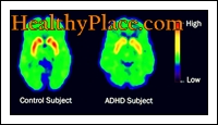 The terms ADD and ADHD have been used interchangeably. However, the updated term, according to the DSM IV, is ADHD (Attention Deficit Hyperactivity Disorder.