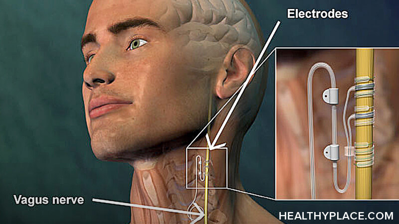 Vagus Nerve Stimulation (Discharge Care)