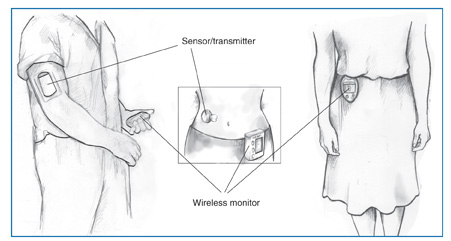 Glucose Monitoring