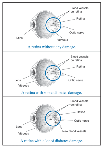 Retina with damage and retina with diabetes damage