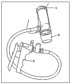 Drawing of a vacuum-constrictor device placed around the penis. Pictured here are the necessary components: (a) a plastic cylinder, which covers the penis; (b) a pump, which draws air out of the cylinder; (c) an elastic ring, which, when fitted over the base of the penis, traps the blood and sustains the erection after the cylinder is removed.