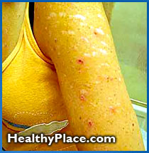 Effects of Compulsive Skin Picking, Chronic Skin Picking ...