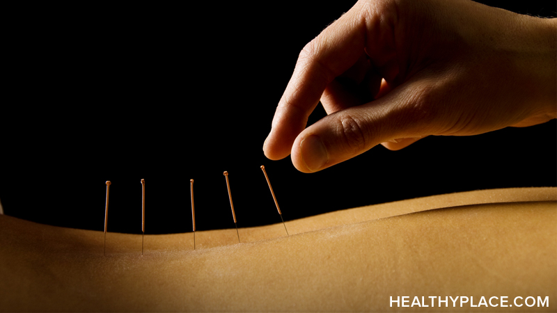 Overview of acupuncture as a natural treatment for depression and whether acupuncture works in treating depression.