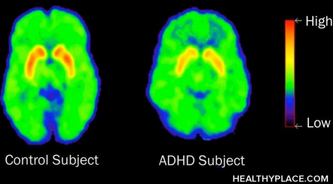 ADHD and ADD are not adjectives that should be used to describe people or behaviors. ADD and ADHD are illnesses that deserve our respect like any other.