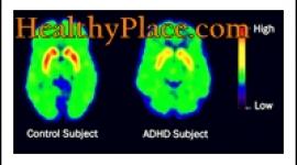 The terms ADD and ADHD have been used interchangeably. However, the updated term, according to the DSM IV, is ADHD (Attention Deficit Hyperactivity Disorder.