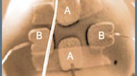 Effects of stimulus intensity and electrode placement on the efficacy and cognitive effects of electroconvulsive therapy (ECT).