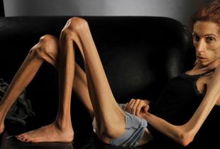Eating Disorders: Anorexia Nervosa - The Most Deadly Mental Illness