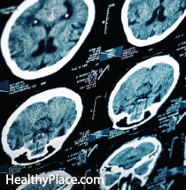 Traumatic brain injury (TBI) is common in deployed soldiers but can a TBI increase a person's risk of combat-related posttraumatic stress disorder (PTSD).