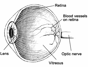 Image of High Blood Glucose Eye Problems